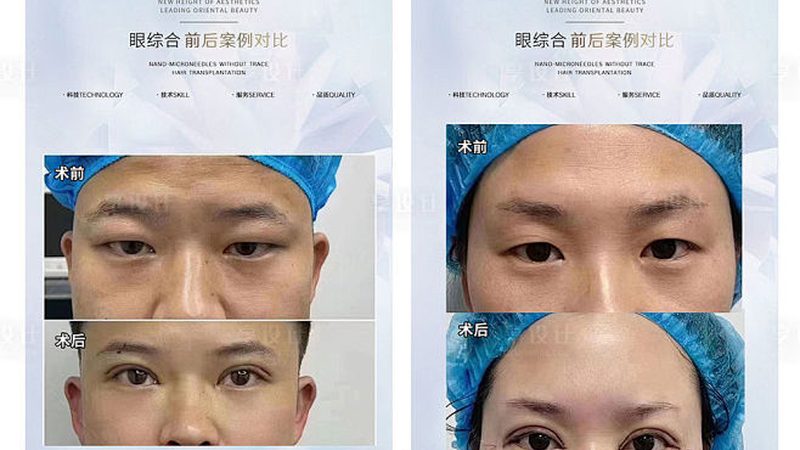 医美耗材报价单：揭秘医美项目成本构成**