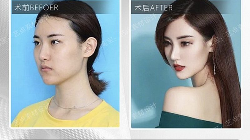 面部提升与埋线提升：揭秘两种提升术的奥秘**