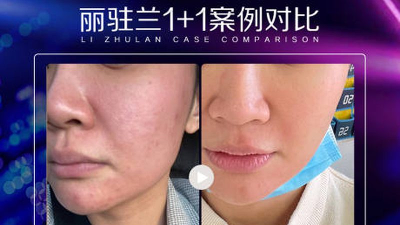 家用瘦脸仪，如何挑选适合的面部紧致提升型号？**